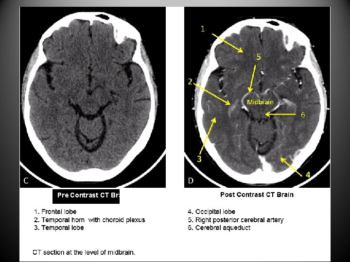 6 Pre Contrast CT Brain 