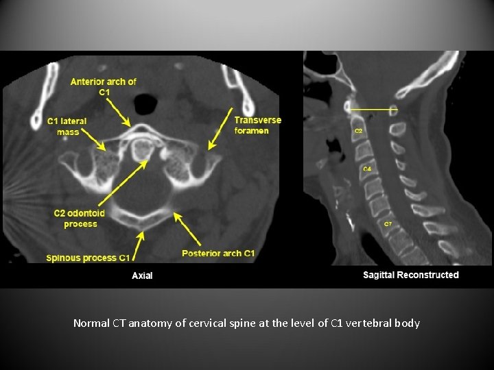 Normal CT anatomy of cervical spine at the level of C 1 vertebral body