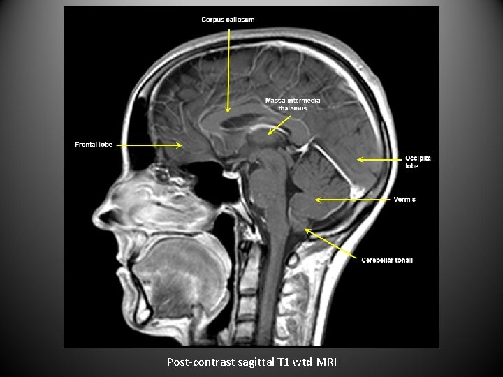 Post-contrast sagittal T 1 wtd MRI 