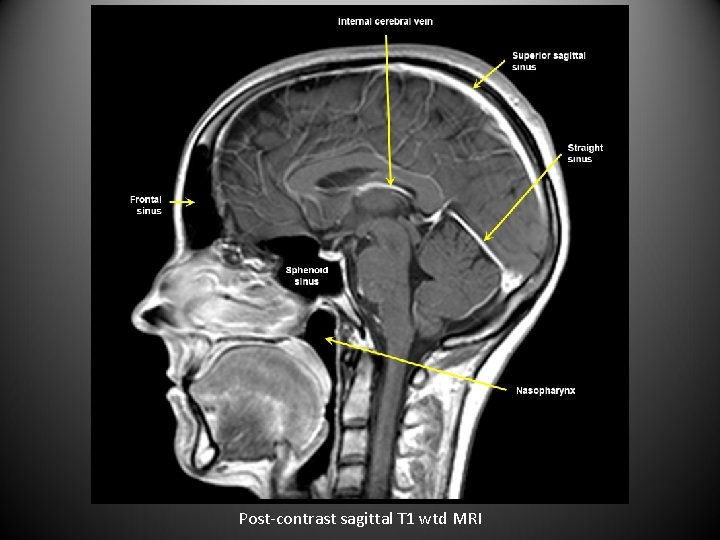 Post-contrast sagittal T 1 wtd MRI 