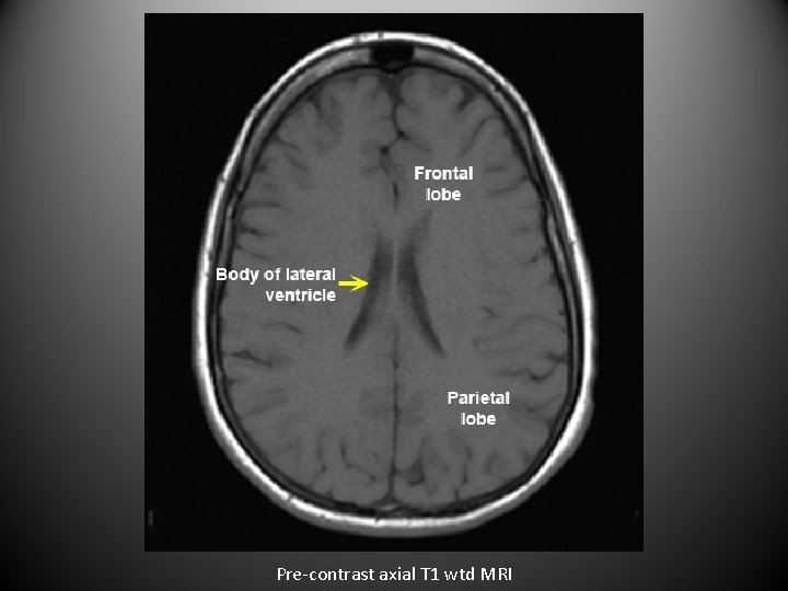 Pre-contrast axial T 1 wtd MRI 