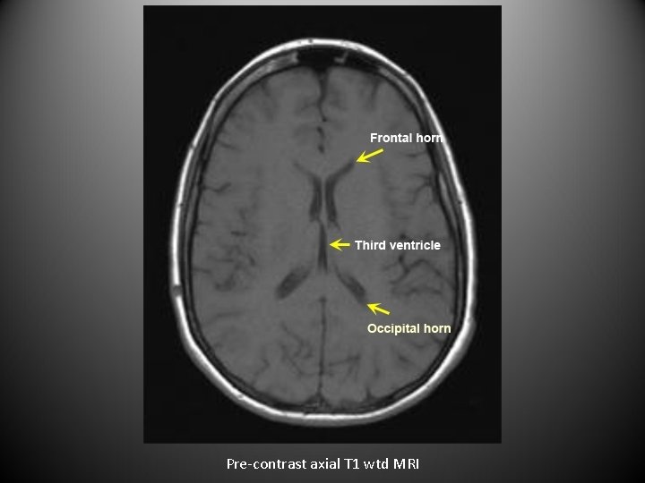 Pre-contrast axial T 1 wtd MRI 