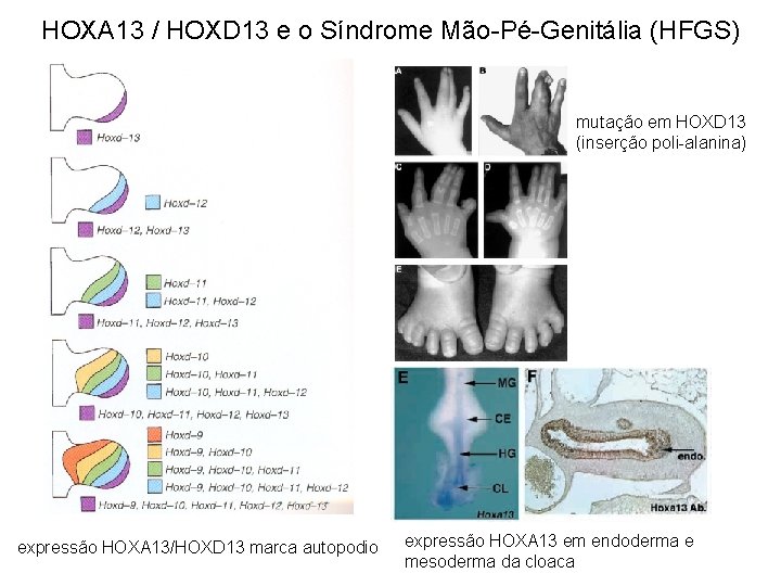 HOXA 13 / HOXD 13 e o Síndrome Mão-Pé-Genitália (HFGS) mutação em HOXD 13