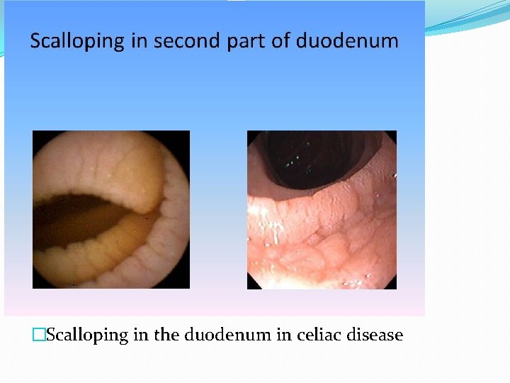 �Scalloping in the duodenum in celiac disease 