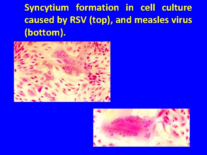 Syncytium formation in cell culture caused by RSV (top), and measles virus (bottom). 