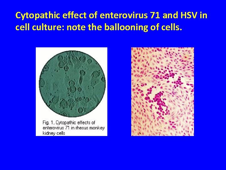 Cytopathic effect of enterovirus 71 and HSV in cell culture: note the ballooning of