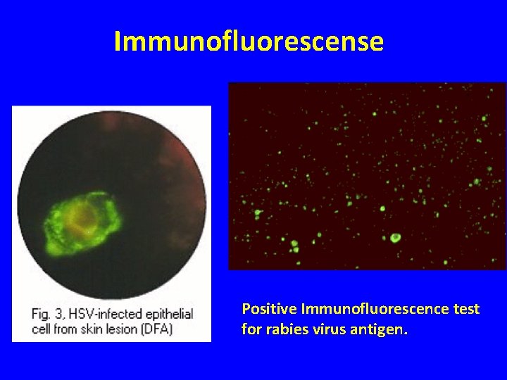 Immunofluorescense Positive Immunofluorescence test for rabies virus antigen. 