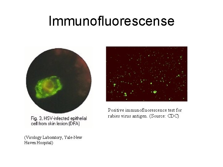Immunofluorescense Positive immunofluorescence test for rabies virus antigen. (Source: CDC) (Virology Laboratory, Yale-New Haven
