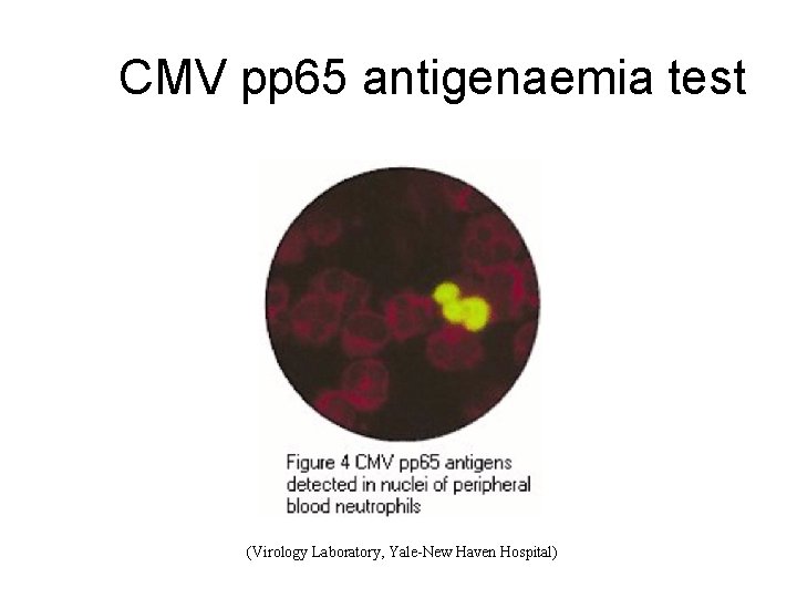 CMV pp 65 antigenaemia test (Virology Laboratory, Yale-New Haven Hospital) 