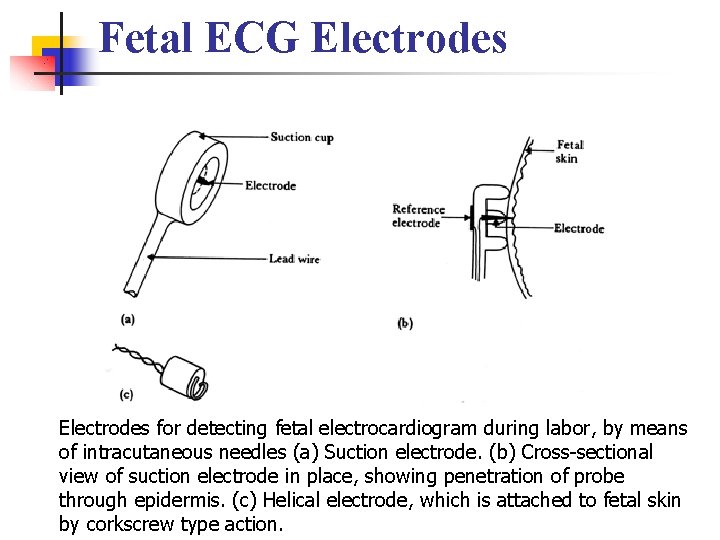 Fetal ECG Electrodes for detecting fetal electrocardiogram during labor, by means of intracutaneous needles