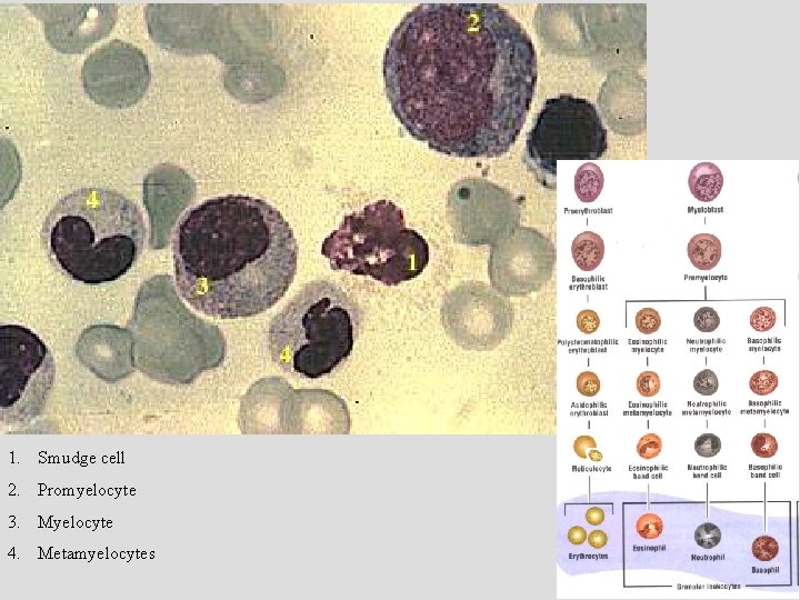 1. Smudge cell 2. Promyelocyte 3. Myelocyte 4. Metamyelocytes 