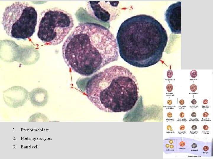 1. Pronormoblast 2. Metamyelocytes 3. Band cell 1. Pronormoblast 2. Metamyelocytes 3. Band cell