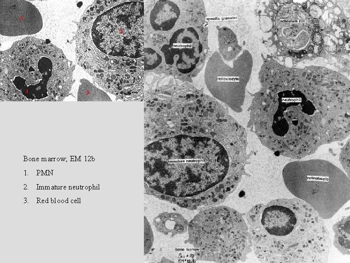Bone marrow; EM 12 b 1. PMN 2. Immature neutrophil 3. Red blood cell