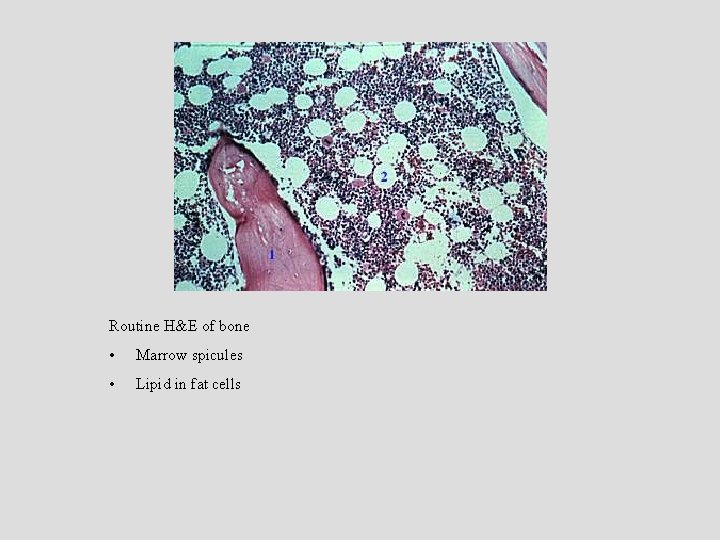 Routine H&E of bone • Marrow spicules • Lipid in fat cells Routine H&E of bone • Marrow spicules • Lipid in fat cells