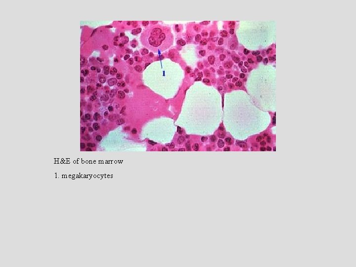 H&E of bone marrow 1. megakaryocytes 