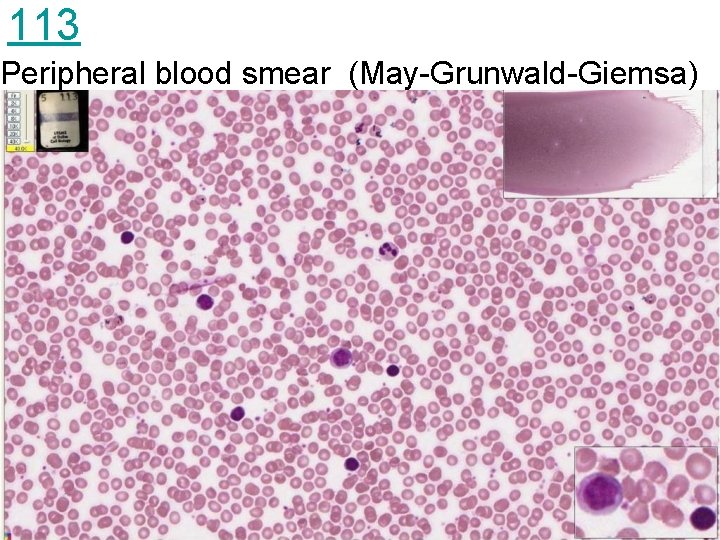 113 Peripheral blood smear (May-Grunwald-Giemsa) 