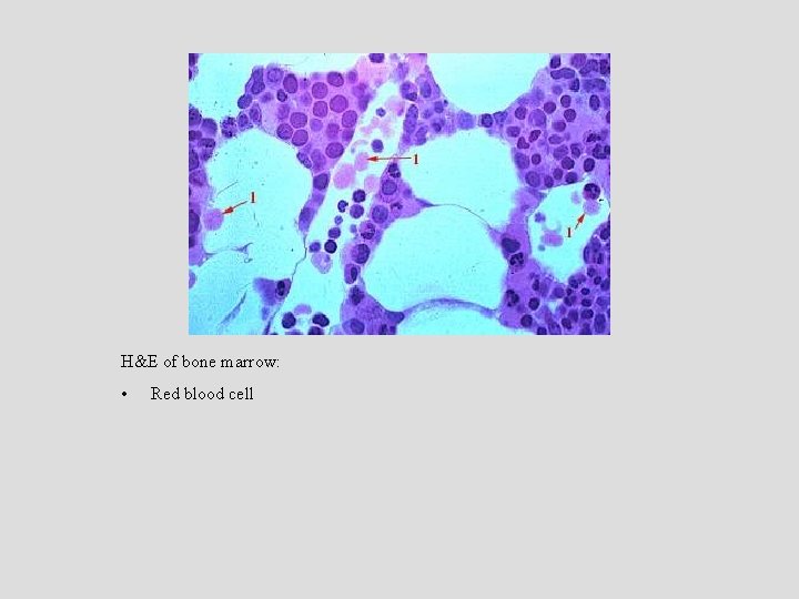 H&E of bone marrow: • Red blood cell 