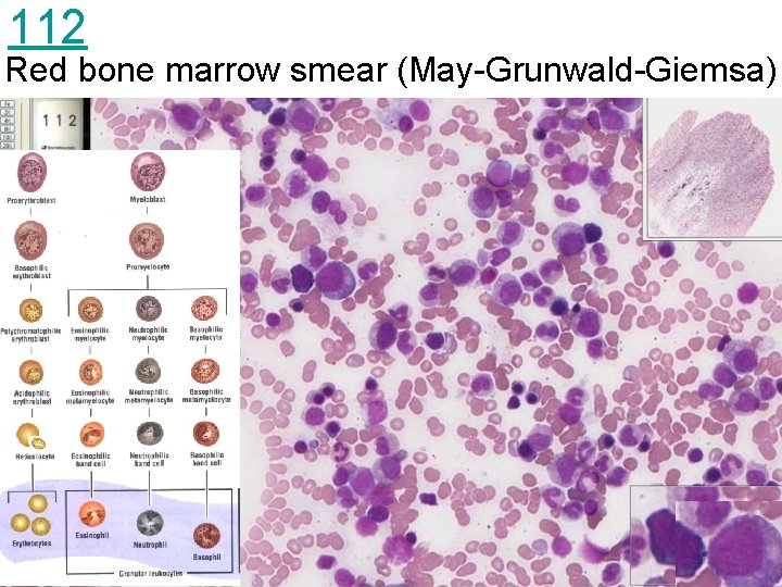 112 Red bone marrow smear (May-Grunwald-Giemsa) 