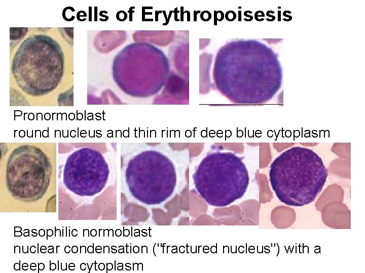 Cells of Erythropoisesis Pronormoblast round nucleus and thin rim of deep blue cytoplasm Basophilic Cells of Erythropoisesis Pronormoblast round nucleus and thin rim of deep blue cytoplasm Basophilic