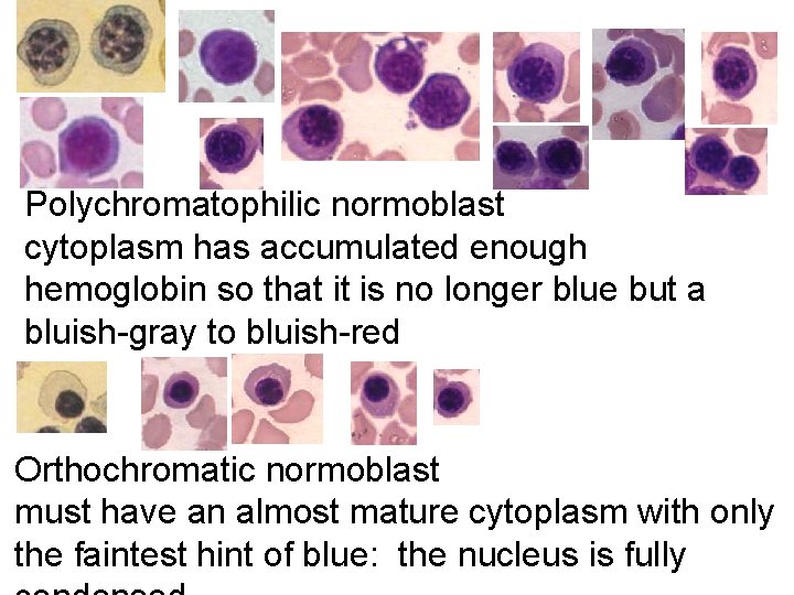 Polychromatophilic normoblast cytoplasm has accumulated enough hemoglobin so that it is no longer Polychromatophilic normoblast cytoplasm has accumulated enough hemoglobin so that it is no longer