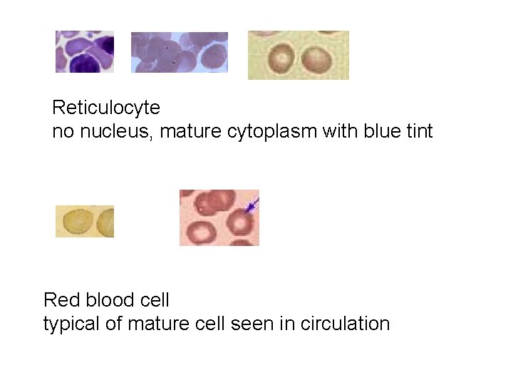 Reticulocyte no nucleus, mature cytoplasm with blue tint Red blood cell typical of mature