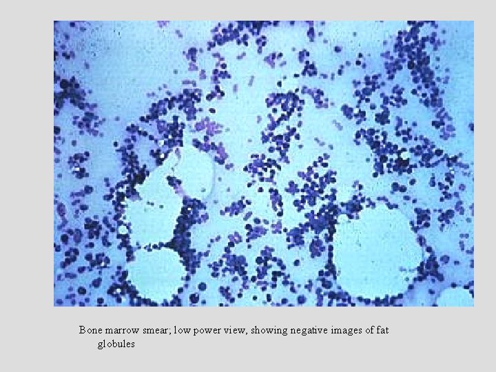 Bone marrow smear; low power view, showing negative images of fat globules Bone marrow smear; low power view, showing negative images of fat globules