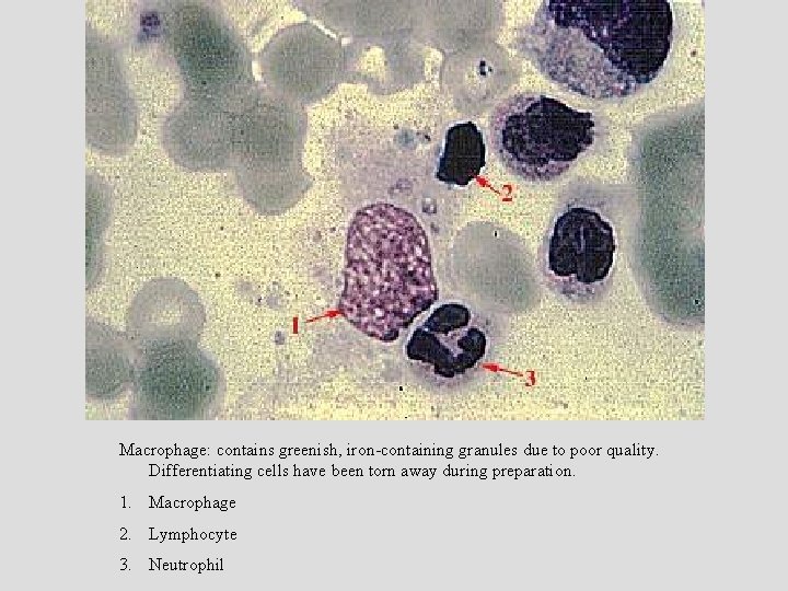 Macrophage: contains greenish, iron-containing granules due to poor quality. Differentiating cells have been torn Macrophage: contains greenish, iron-containing granules due to poor quality. Differentiating cells have been torn