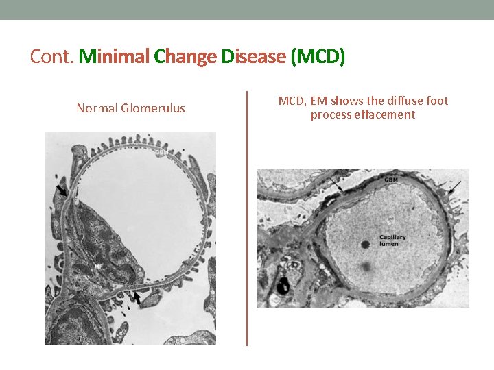 Cont. Minimal Change Disease (MCD) Normal Glomerulus MCD, EM shows the diffuse foot process