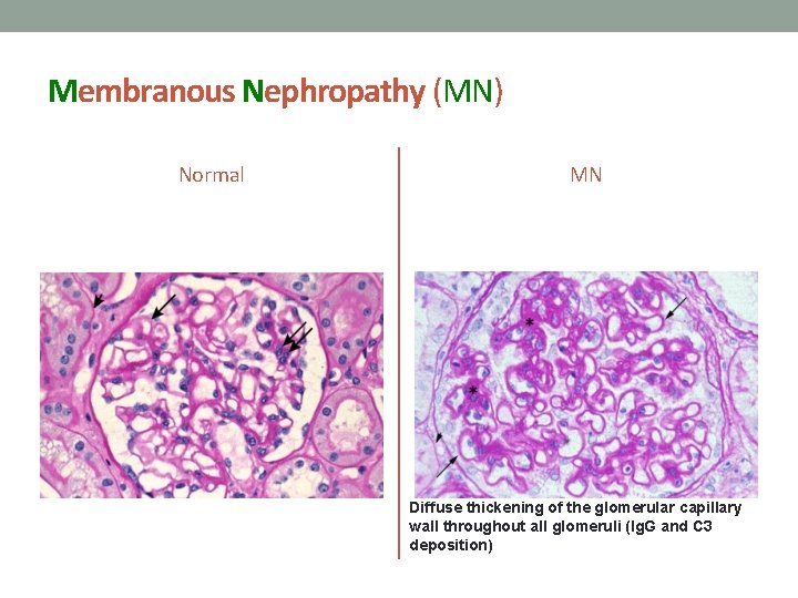 Membranous Nephropathy (MN) Normal MN Diffuse thickening of the glomerular capillary wall throughout all