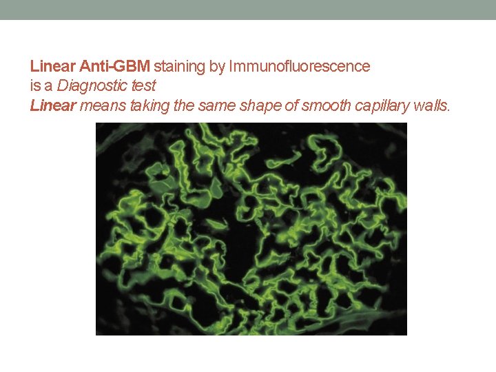 Linear Anti-GBM staining by Immunofluorescence is a Diagnostic test Linear means taking the same