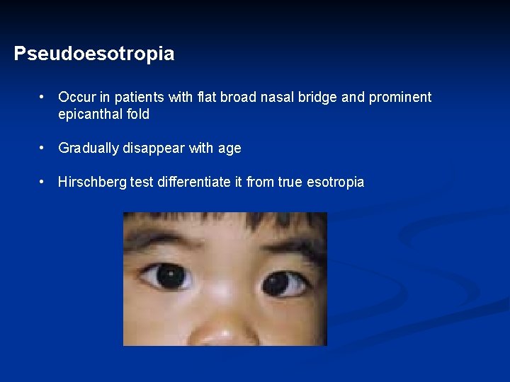 Pseudoesotropia • Occur in patients with flat broad nasal bridge and prominent epicanthal fold