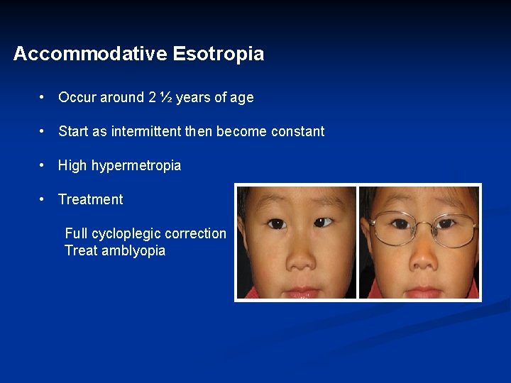 Accommodative Esotropia • Occur around 2 ½ years of age • Start as intermittent