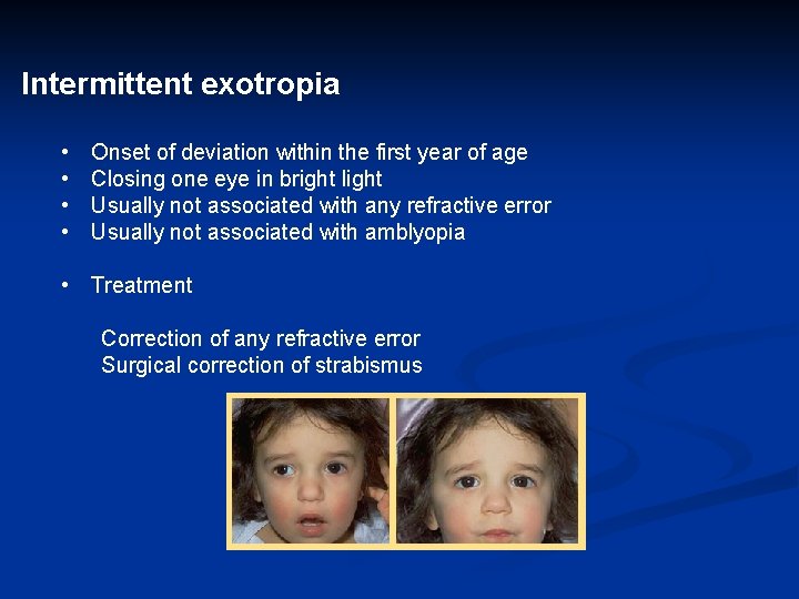 Intermittent exotropia • • Onset of deviation within the first year of age Closing