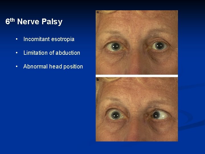 6 th Nerve Palsy • Incomitant esotropia • Limitation of abduction • Abnormal head