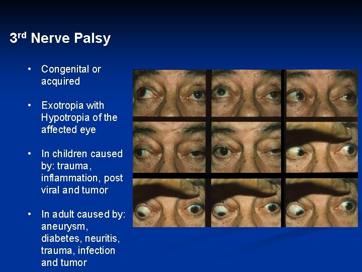 3 rd Nerve Palsy • Congenital or acquired • Exotropia with Hypotropia of the