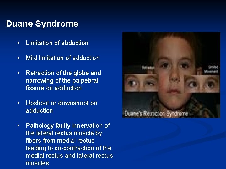 Duane Syndrome • Limitation of abduction • Mild limitation of adduction • Retraction of