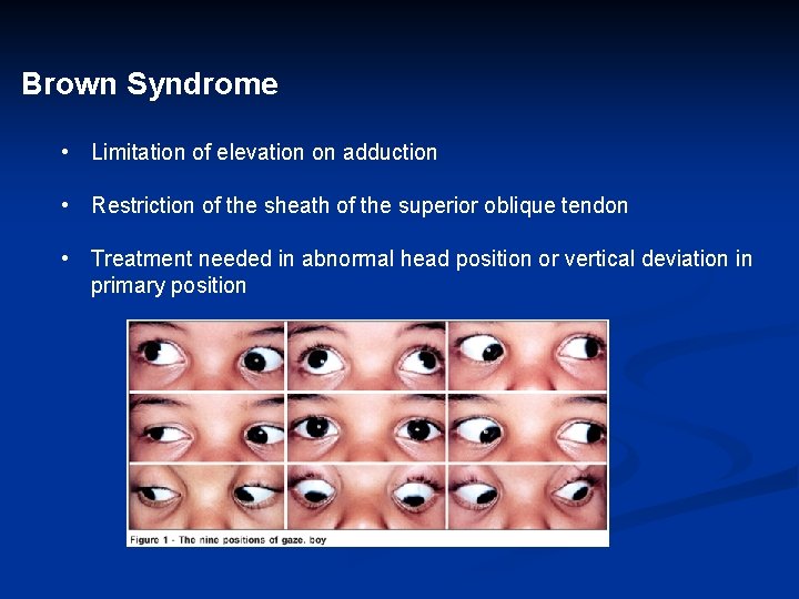 Brown Syndrome • Limitation of elevation on adduction • Restriction of the sheath of