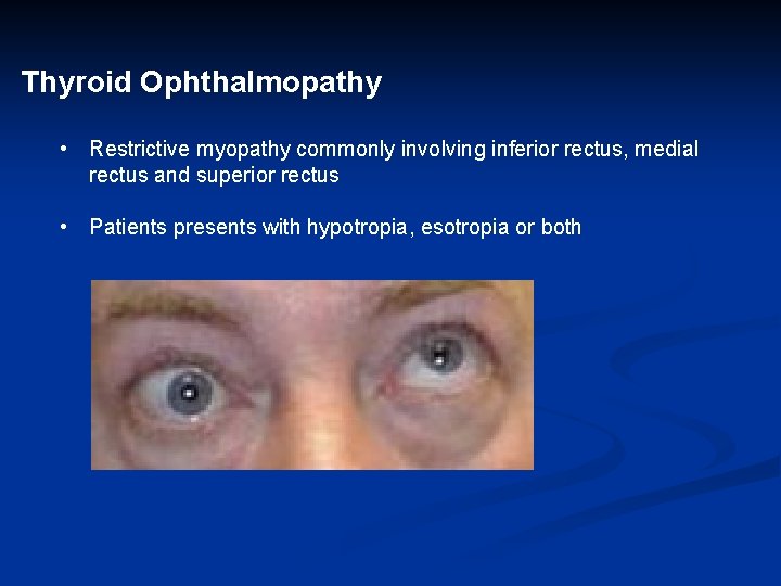 Thyroid Ophthalmopathy • Restrictive myopathy commonly involving inferior rectus, medial rectus and superior rectus