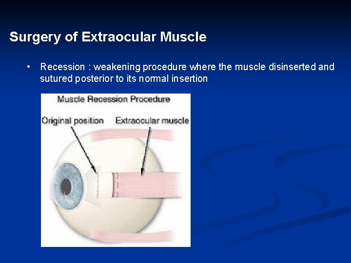 Surgery of Extraocular Muscle • Recession : weakening procedure where the muscle disinserted and