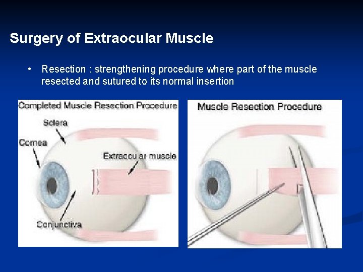 Surgery of Extraocular Muscle • Resection : strengthening procedure where part of the muscle