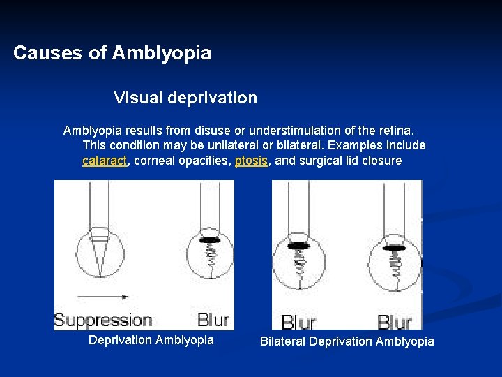 Causes of Amblyopia Visual deprivation Amblyopia results from disuse or understimulation of the retina.
