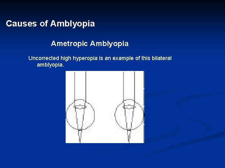 Causes of Amblyopia Ametropic Amblyopia Uncorrected high hyperopia is an example of this bilateral