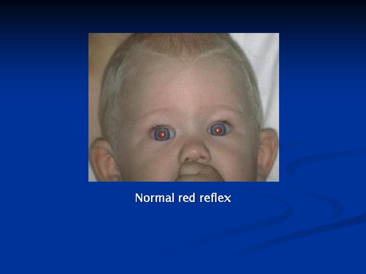 Normal red reflex 