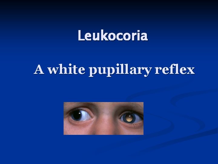 Leukocoria A white pupillary reflex 