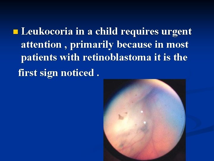 n Leukocoria in a child requires urgent attention , primarily because in most patients