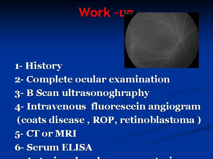 Work –up 1 - History 2 - Complete ocular examination 3 - B Scan