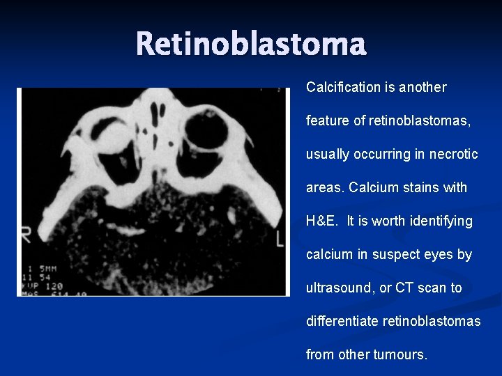 Retinoblastoma Calcification is another feature of retinoblastomas, usually occurring in necrotic areas. Calcium stains