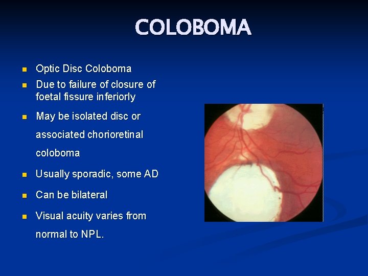 COLOBOMA n Optic Disc Coloboma n Due to failure of closure of foetal fissure