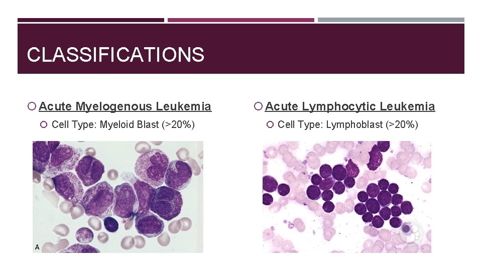 CLASSIFICATIONS Acute Myelogenous Leukemia Acute Lymphocytic Leukemia Cell Type: Myeloid Blast (>20%) Cell Type: