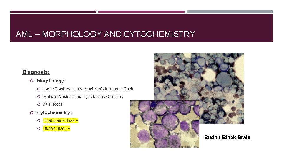 AML – MORPHOLOGY AND CYTOCHEMISTRY Diagnosis: Morphology: Large Blasts with Low Nuclear/Cytoplasmic Radio Multiple
